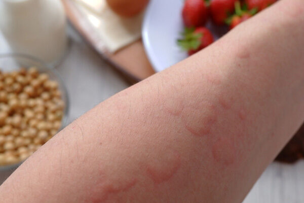 are hives contagious