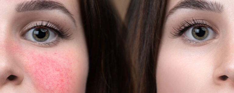 Lupus Rash Vs Rosacea What Are The Similarities And Differences 