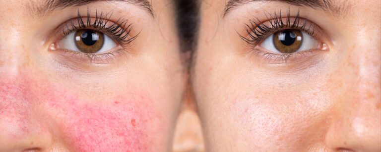 Lupus rash vs Rosacea: The True Cause of Facial Redness