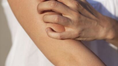 Do You Have Chronic Hives