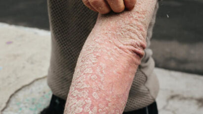 Itching due to Prurigo Nodularis