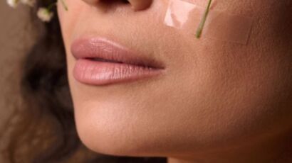 have lupus butterfly rashes