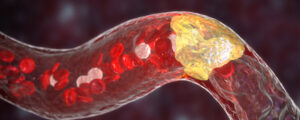 Atherosclerosis Vs Arteriosclerosis: Signs And Treatments