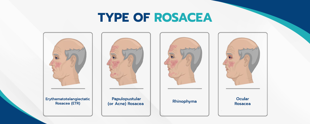 type of rosacea