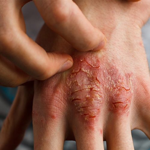 dry skin dermatitis flexural eczema