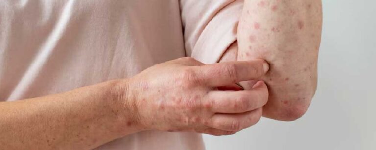 Prurigo Nodularis Pictures Signs Causes And Management Of Pn 5460