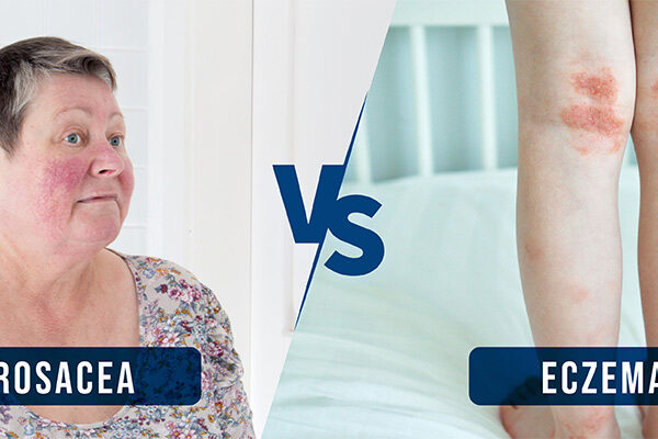 Rosacea vs Eczema How to Tell the Difference?