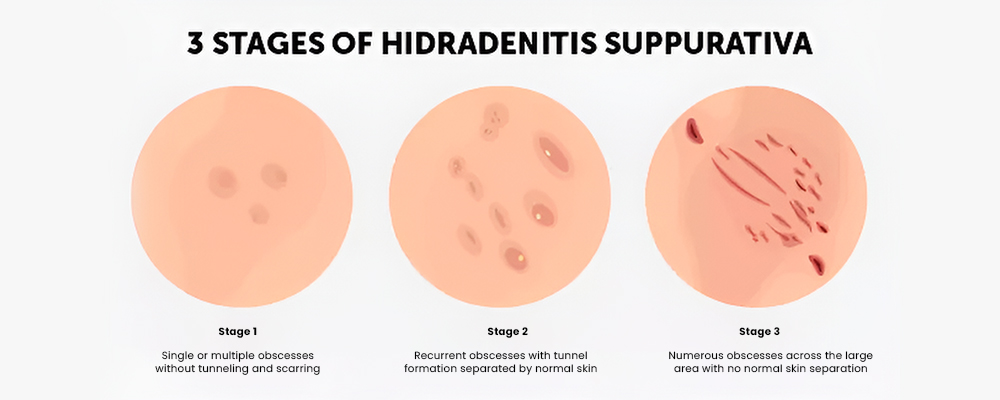 Staging of Hidradenitis Suppurativa