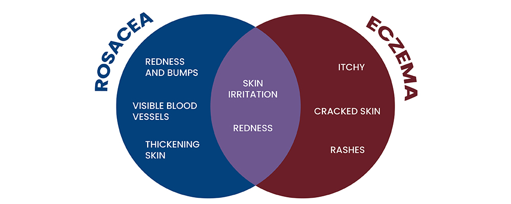 Symptoms of Rosacea vs symptoms of eczema