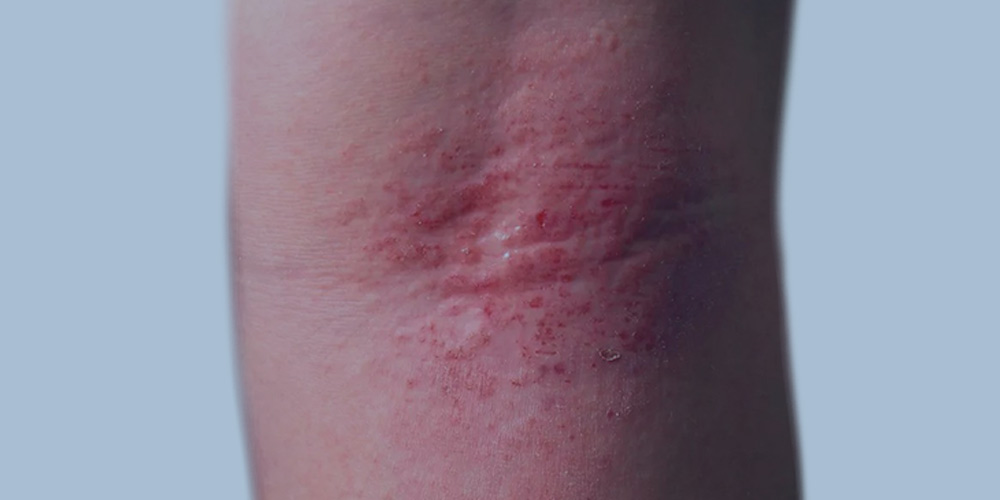 Intrinsic Eczema Picture
