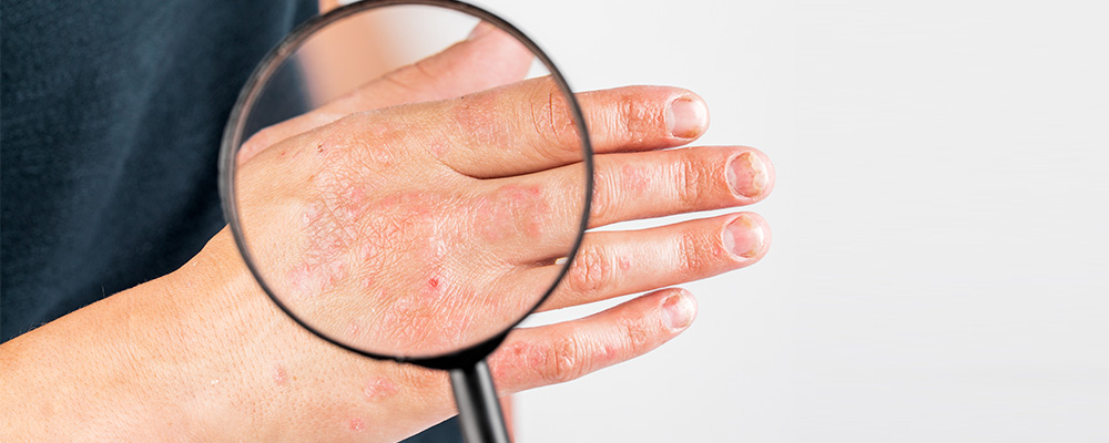 What is Intrinsic Eczema