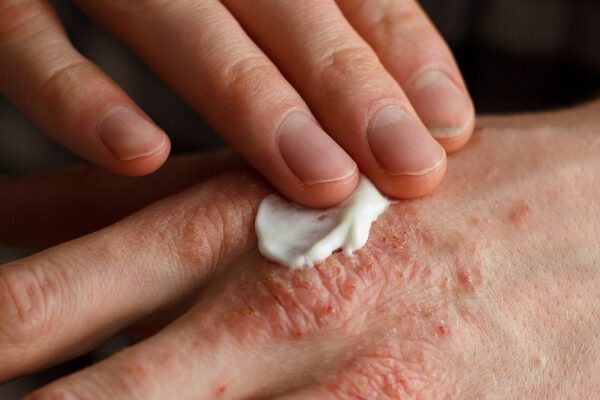 Eczema Quiz: Do I have Eczema? Check Your Symptoms