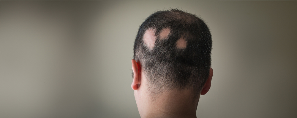 Alopecia Areata Self-Care