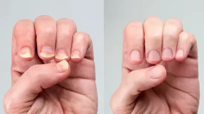 Nail Psoriasis Vs Fungus