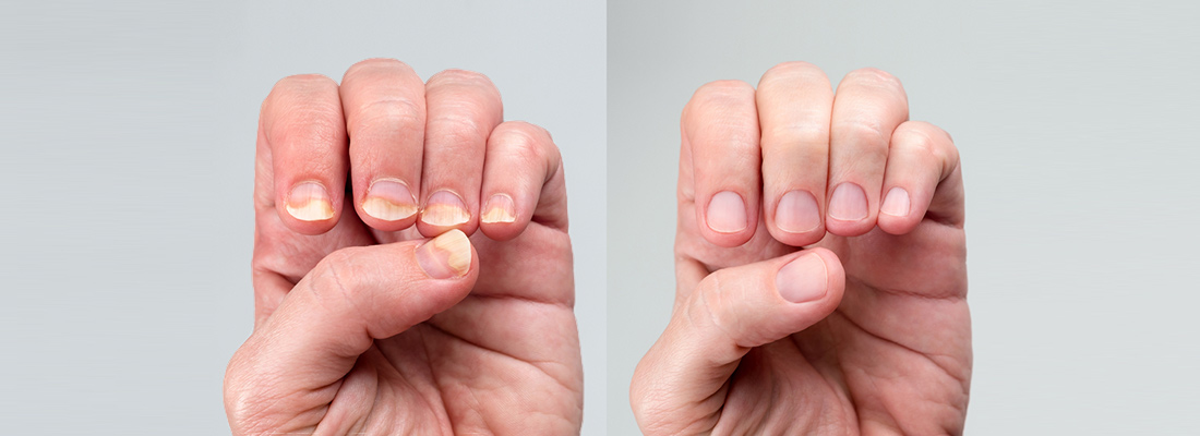 Nail Psoriasis vs. Fungus