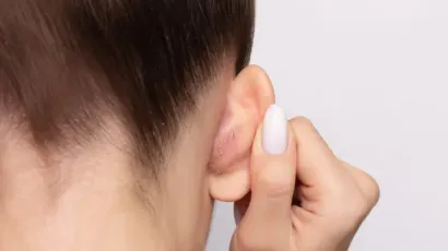 Psoriasis in Ears