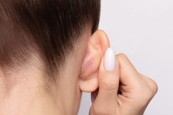 Psoriasis in Ears