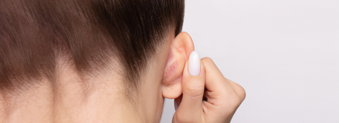 Psoriasis in Ears