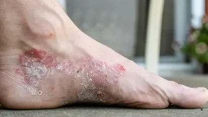 Psoriasis on Feet