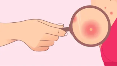 Armpit Pimples