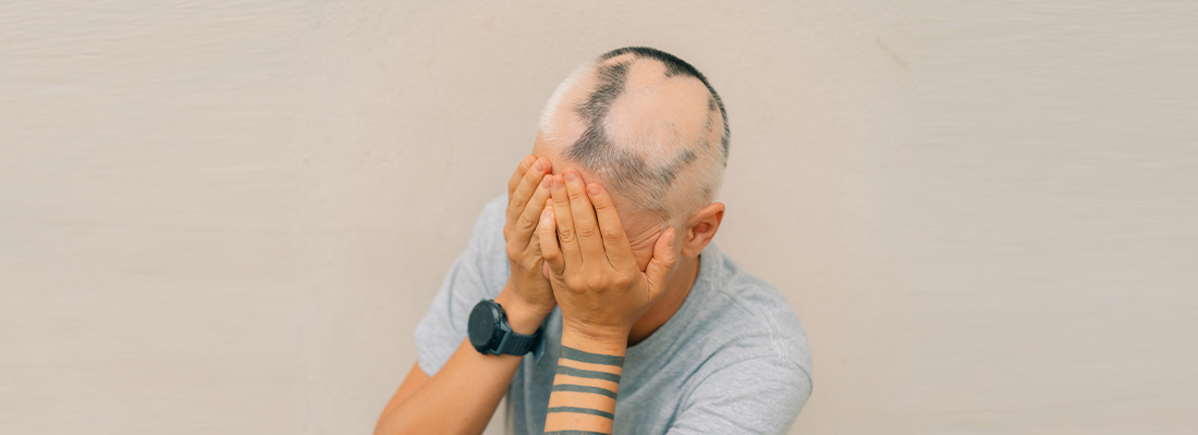 Retrograde Alopecia