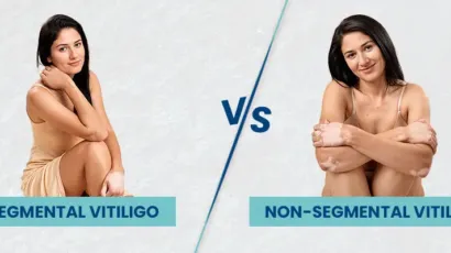 Non Segmental Vs Segmental Vitiligo
