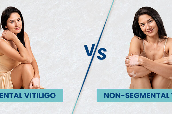 Non-Segmental vs. Segmental Vitiligo