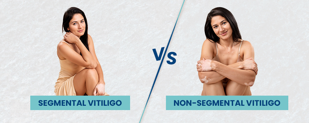 Non-Segmental vs. Segmental Vitiligo