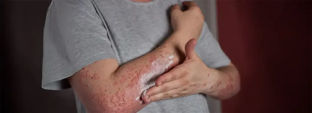 Papular Rash