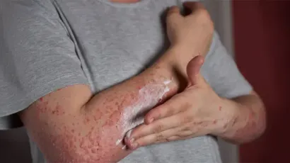 Papular Rash