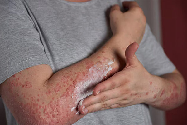 Papular Rash