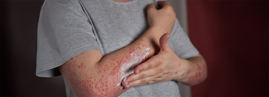 Papular Rash