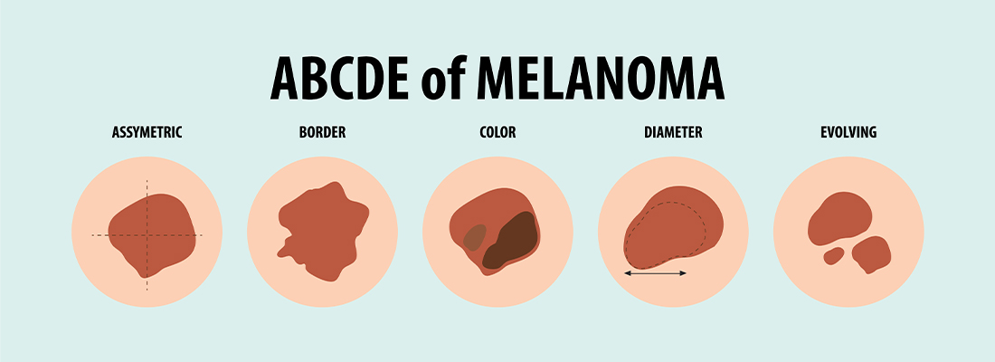ABCDEs of Melanoma to Guide your Self-Exams