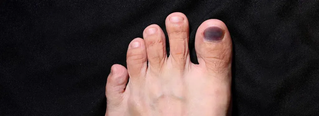 Black Toenail and Diabetes
