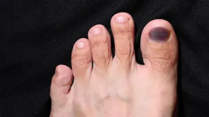 Black Toenail and Diabetes
