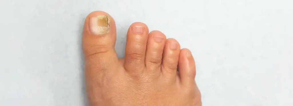 Kidney Disease Nails