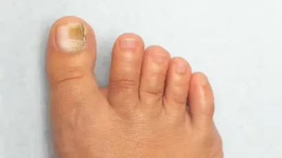 Kidney Disease Nails