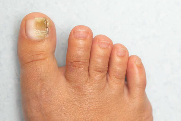 Kidney Disease Nails