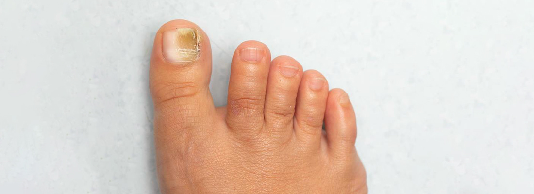 Kidney Disease Nails