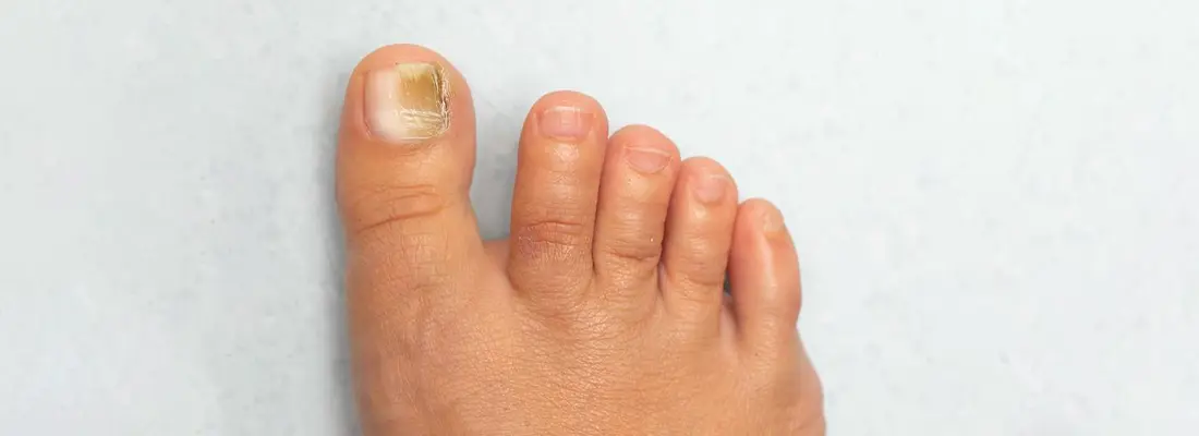 Kidney Disease Nails