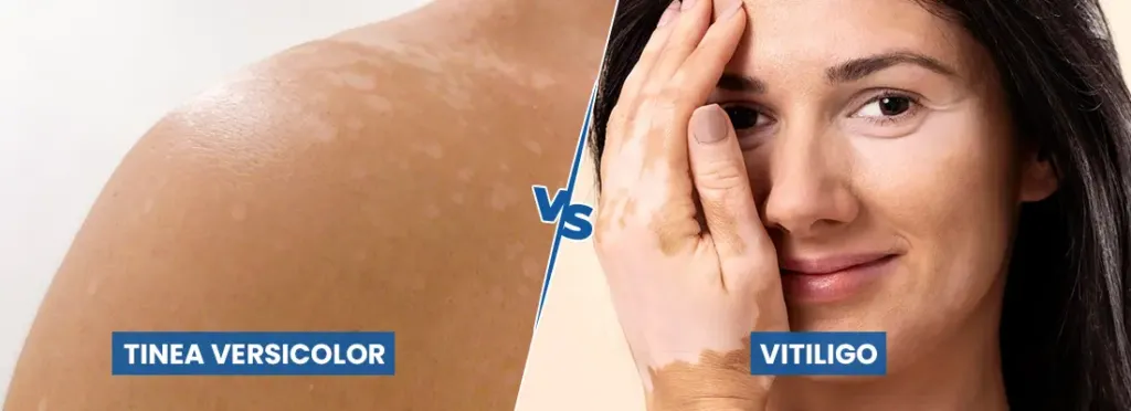 Tinea Versicolor vs Vitiligo