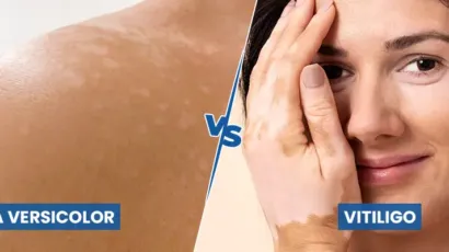 Tinea Versicolor vs Vitiligo