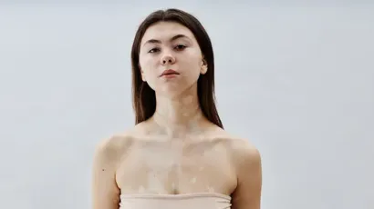 World Vitiligo Day 2025