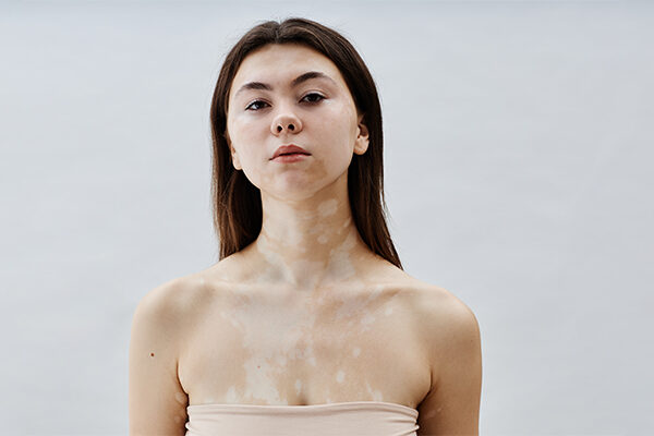 World Vitiligo Day 2025