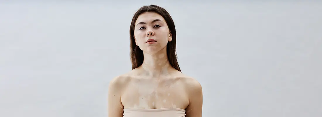 World Vitiligo Day 2025