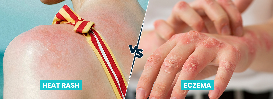 Heat Rash vs Eczema