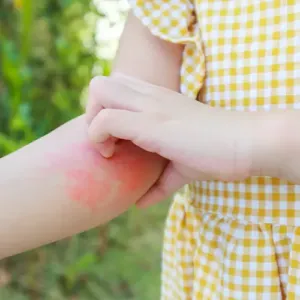 little-girl-has-skin-rash-flexural-eczema-her-arm