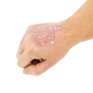 psoriasis-vulgaris-on-above-hand