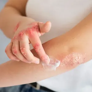 psoriasis-vulgaris-on-elbow