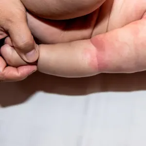 skin-arms-baby-newborn-is-red-rash-caused-by-flexural-eczema